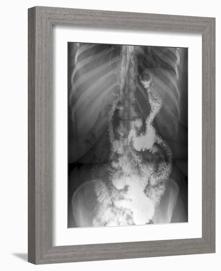 Gastric Bypass Surgery, X-ray-ZEPHYR-Framed Photographic Print