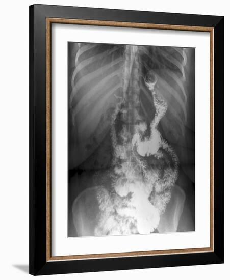 Gastric Bypass Surgery, X-ray-ZEPHYR-Framed Photographic Print