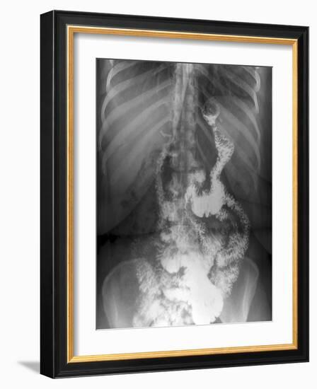 Gastric Bypass Surgery, X-ray-ZEPHYR-Framed Photographic Print