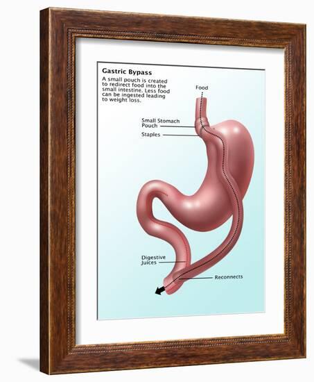 Gastric Bypass Surgery-Gwen Shockey-Framed Giclee Print