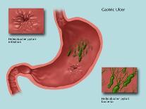 Helicobacter Pylori Infection, Illustration-Gwen Shockey-Giclee Print