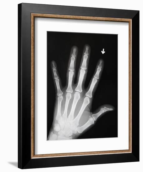 Hand Bones-Simon Jarratt-Framed Photographic Print