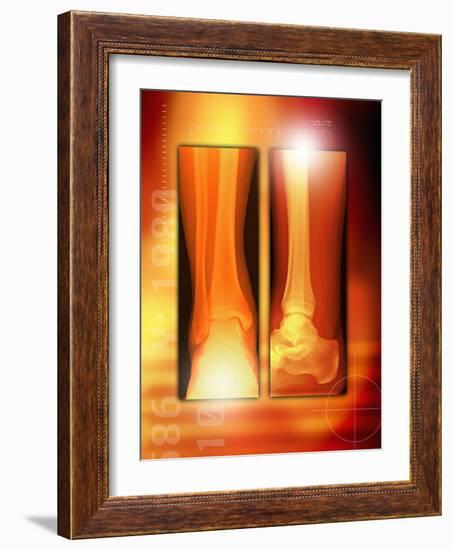 Healing Ankle Fracture, X-ray-Miriam Maslo-Framed Photographic Print