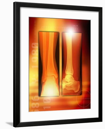 Healing Ankle Fracture, X-ray-Miriam Maslo-Framed Photographic Print