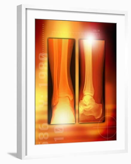 Healing Ankle Fracture, X-ray-Miriam Maslo-Framed Photographic Print