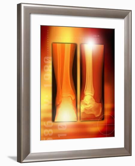 Healing Ankle Fracture, X-ray-Miriam Maslo-Framed Photographic Print