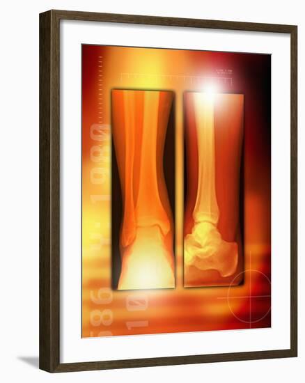 Healing Ankle Fracture, X-ray-Miriam Maslo-Framed Photographic Print