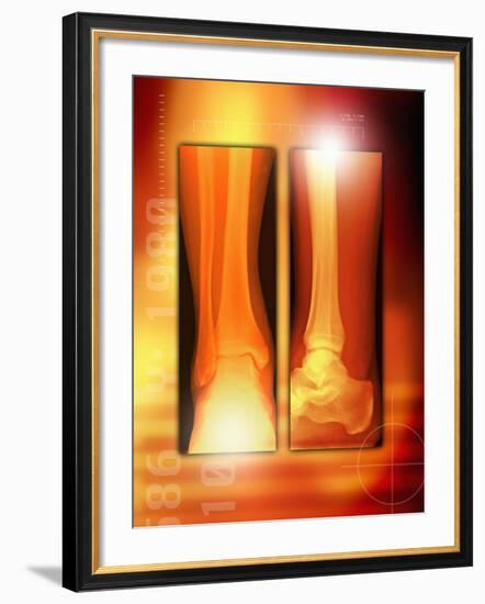 Healing Ankle Fracture, X-ray-Miriam Maslo-Framed Photographic Print