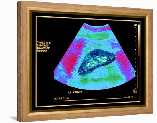 Healthy Kidney Measured, Ultrasound Scan-Science Photo Library-Framed Premier Image Canvas