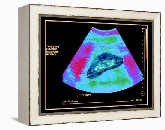 Healthy Kidney Measured, Ultrasound Scan-Science Photo Library-Framed Premier Image Canvas