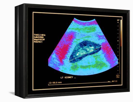 Healthy Kidney Measured, Ultrasound Scan-Science Photo Library-Framed Premier Image Canvas