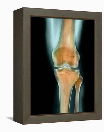 Healthy Knee, X-ray-Science Photo Library-Framed Premier Image Canvas