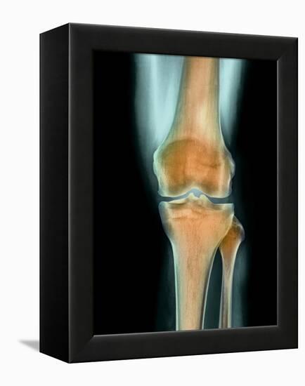 Healthy Knee, X-ray-Science Photo Library-Framed Premier Image Canvas