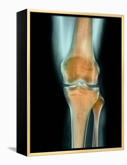 Healthy Knee, X-ray-Science Photo Library-Framed Premier Image Canvas