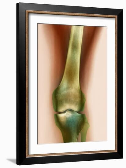 Healthy Knee, X-ray-Science Photo Library-Framed Photographic Print