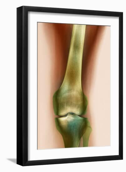 Healthy Knee, X-ray-Science Photo Library-Framed Photographic Print