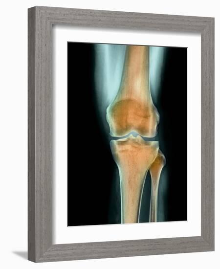 Healthy Knee, X-ray-Science Photo Library-Framed Photographic Print