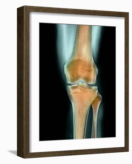 Healthy Knee, X-ray-Science Photo Library-Framed Photographic Print