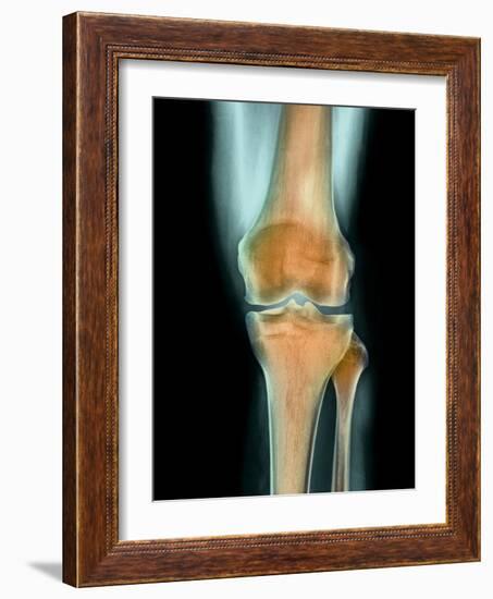 Healthy Knee, X-ray-Science Photo Library-Framed Photographic Print