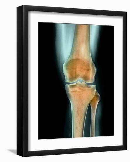 Healthy Knee, X-ray-Science Photo Library-Framed Photographic Print