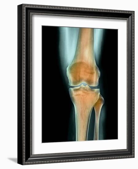 Healthy Knee, X-ray-Science Photo Library-Framed Photographic Print