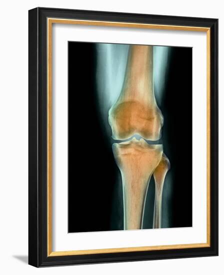 Healthy Knee, X-ray-Science Photo Library-Framed Photographic Print