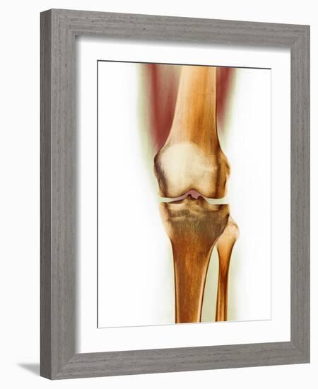 Healthy Knee, X-ray-Science Photo Library-Framed Photographic Print