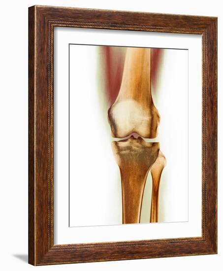 Healthy Knee, X-ray-Science Photo Library-Framed Photographic Print