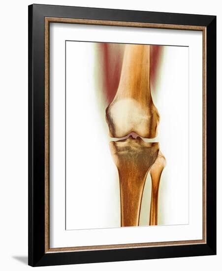 Healthy Knee, X-ray-Science Photo Library-Framed Photographic Print