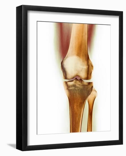 Healthy Knee, X-ray-Science Photo Library-Framed Photographic Print