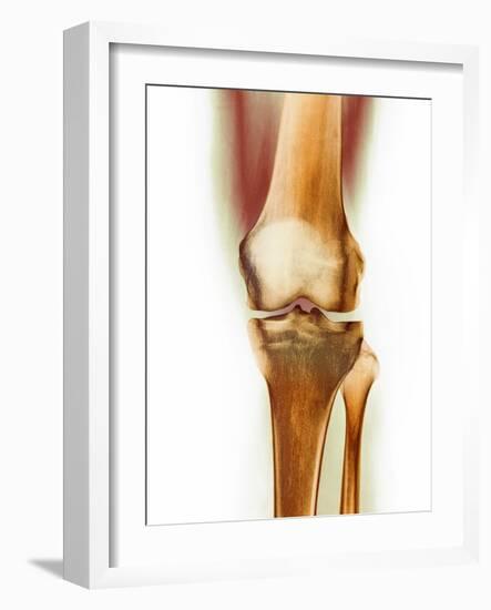 Healthy Knee, X-ray-Science Photo Library-Framed Photographic Print