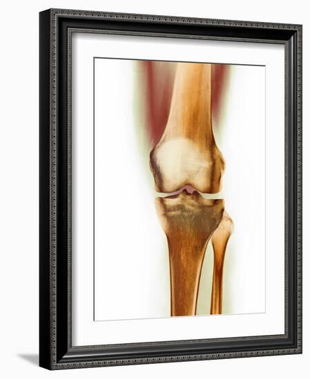 Healthy Knee, X-ray-Science Photo Library-Framed Photographic Print