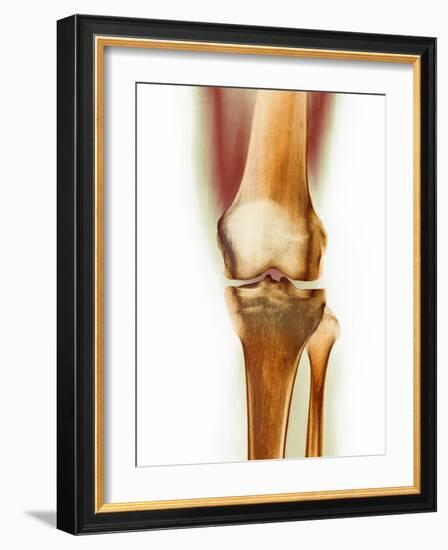 Healthy Knee, X-ray-Science Photo Library-Framed Photographic Print