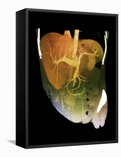 Healthy Liver, CT Scan-ZEPHYR-Framed Premier Image Canvas