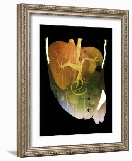 Healthy Liver, CT Scan-ZEPHYR-Framed Photographic Print