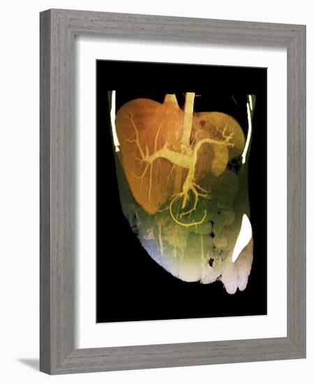 Healthy Liver, CT Scan-ZEPHYR-Framed Photographic Print