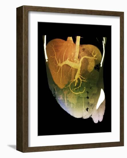 Healthy Liver, CT Scan-ZEPHYR-Framed Photographic Print