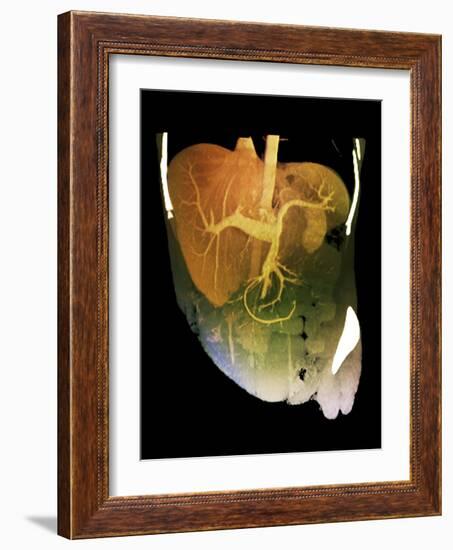 Healthy Liver, CT Scan-ZEPHYR-Framed Photographic Print