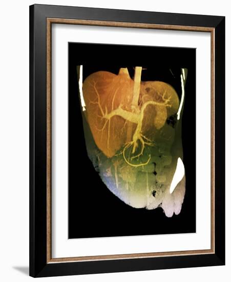 Healthy Liver, CT Scan-ZEPHYR-Framed Photographic Print