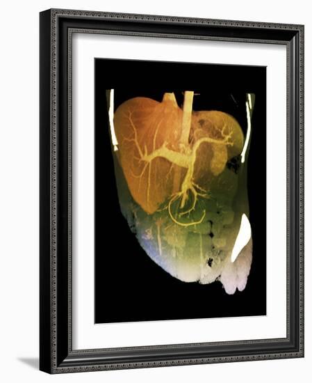 Healthy Liver, CT Scan-ZEPHYR-Framed Photographic Print