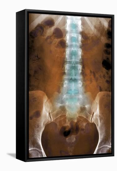 Healthy Lower Spine, X-ray-Du Cane Medical-Framed Premier Image Canvas