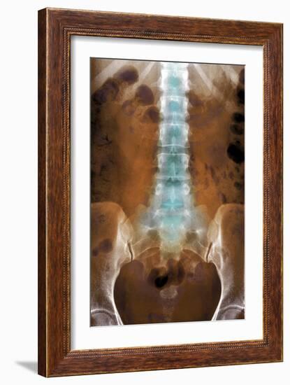 Healthy Lower Spine, X-ray-Du Cane Medical-Framed Photographic Print