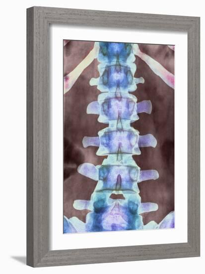 Healthy Lower Spine, X-ray-Science Photo Library-Framed Photographic Print