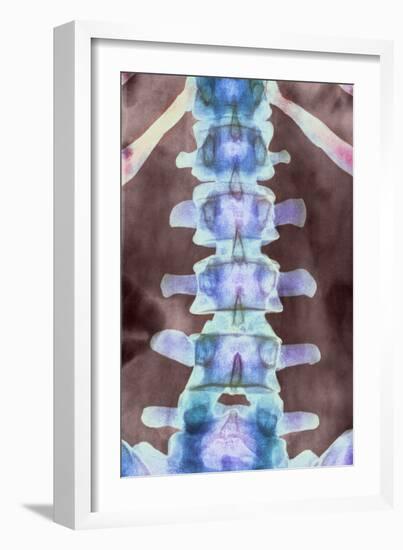 Healthy Lower Spine, X-ray-Science Photo Library-Framed Photographic Print