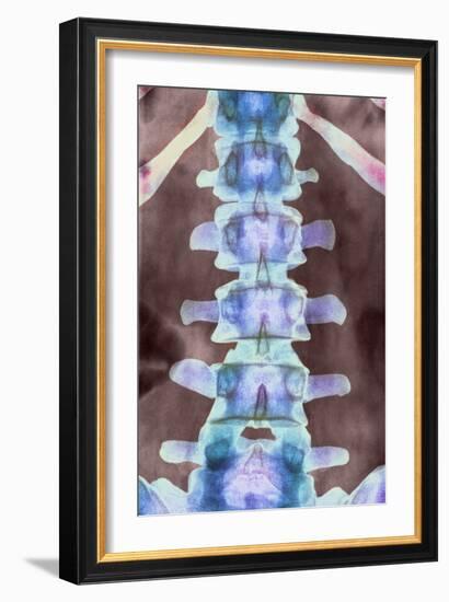 Healthy Lower Spine, X-ray-Science Photo Library-Framed Photographic Print