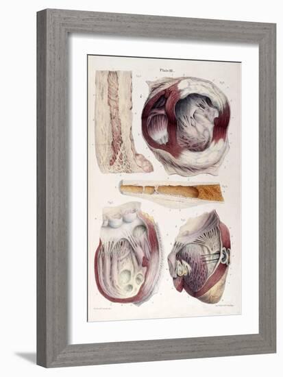 Heart, Aneurysm, Illustration, 1838-Science Source-Framed Giclee Print