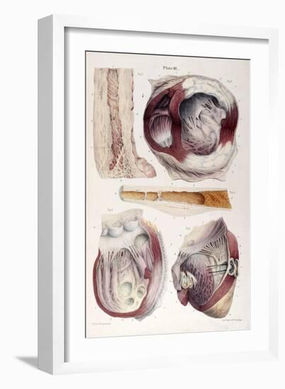 Heart, Aneurysm, Illustration, 1838-Science Source-Framed Giclee Print
