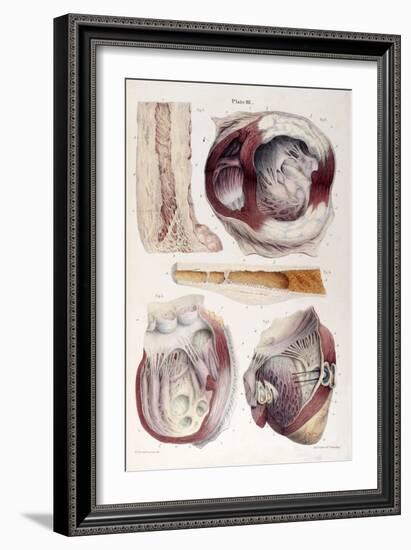 Heart, Aneurysm, Illustration, 1838-Science Source-Framed Giclee Print