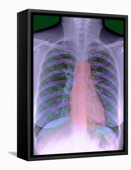 Heart, Chest X-ray-Du Cane Medical-Framed Premier Image Canvas