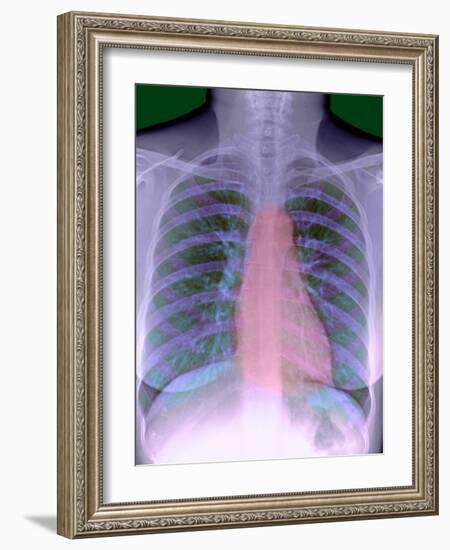 Heart, Chest X-ray-Du Cane Medical-Framed Photographic Print